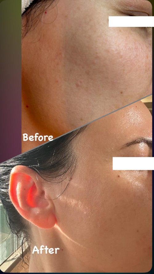 Before and After