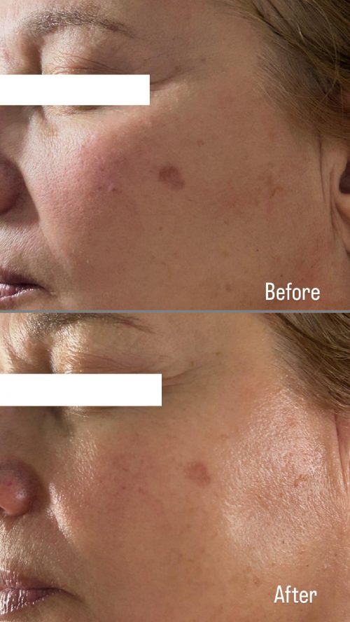 Before and After